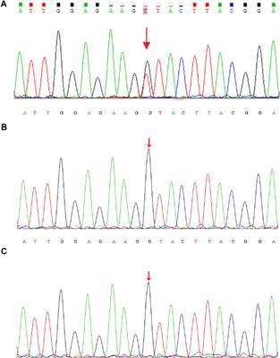 Case Report: Hemophagocytic Lymphohistiocytosis Prior to the Onset of Leukemia in a Boy With CDK13-Related Disorder